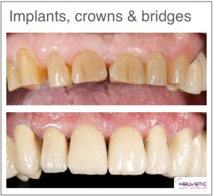 Dental implant cost Helvetic Clinics