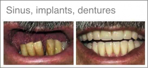 jacky-teeth-with-treatment-name