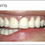 dental crown
