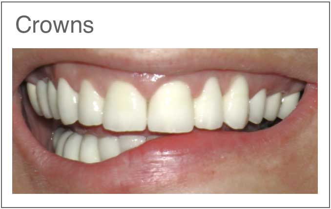 dental crown